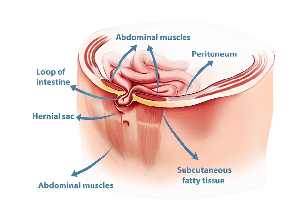 Abdominal hernia repair placement detail